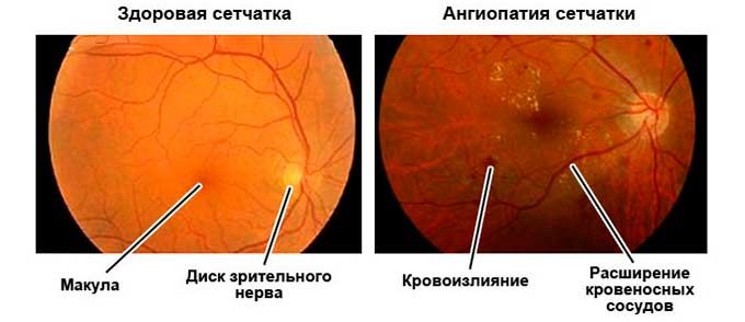 ангиопатия