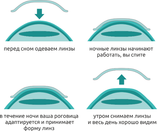 при астигматизме можно носить линзы