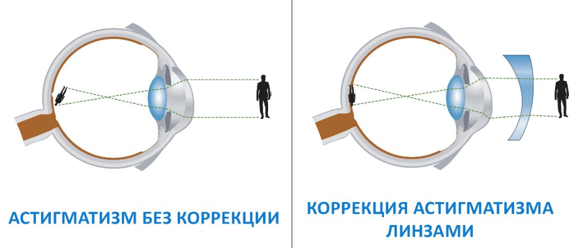 астигматизм линзы носить