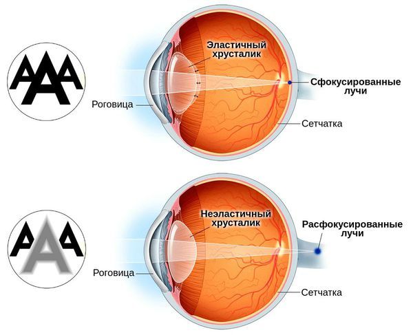 пресбиопия