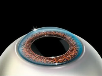 этапы ласик, lasik