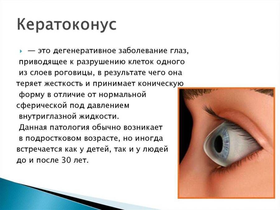 кератоконус и астигматизм