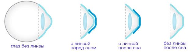 глаз при близорукости