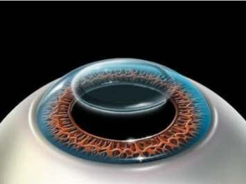 этапы ласик, lasik, без швов