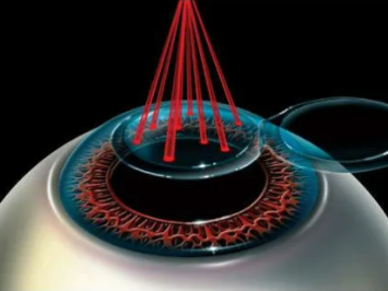 этапы ласик, воздействие лазера