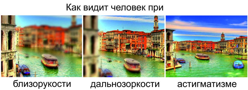 Близорукость, дальнозоркость, астигматизм