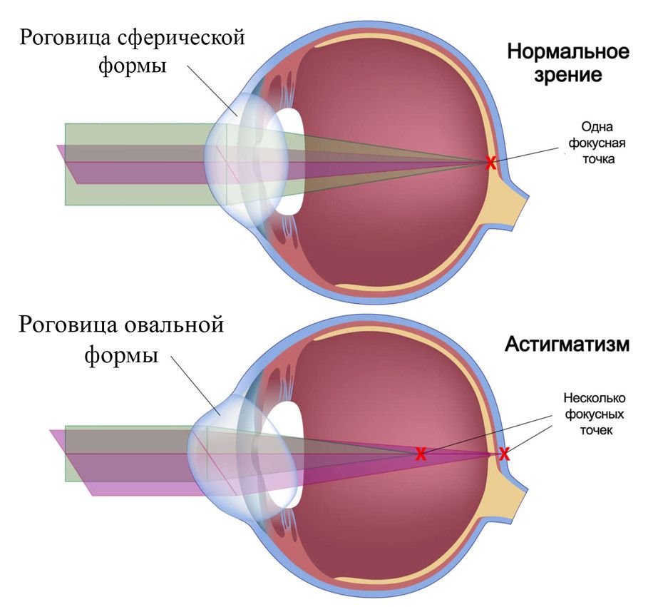 линзы для зрения астигматизм