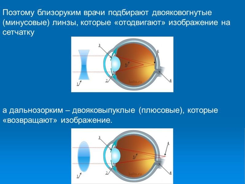 близорукость это минус