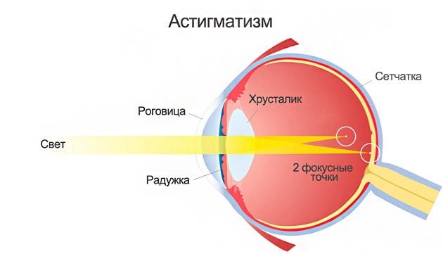 врожденный астигматизм