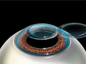 этапы ласик, lasik, формирование лоскута